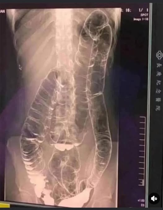 Understanding Severe Constipation and Toxic Megacolon: Causes, Risks, and Prevention