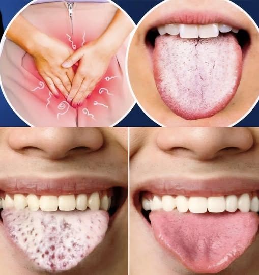 If You Have a White Tongue, It Could Be a Sign of These Common Health Issues